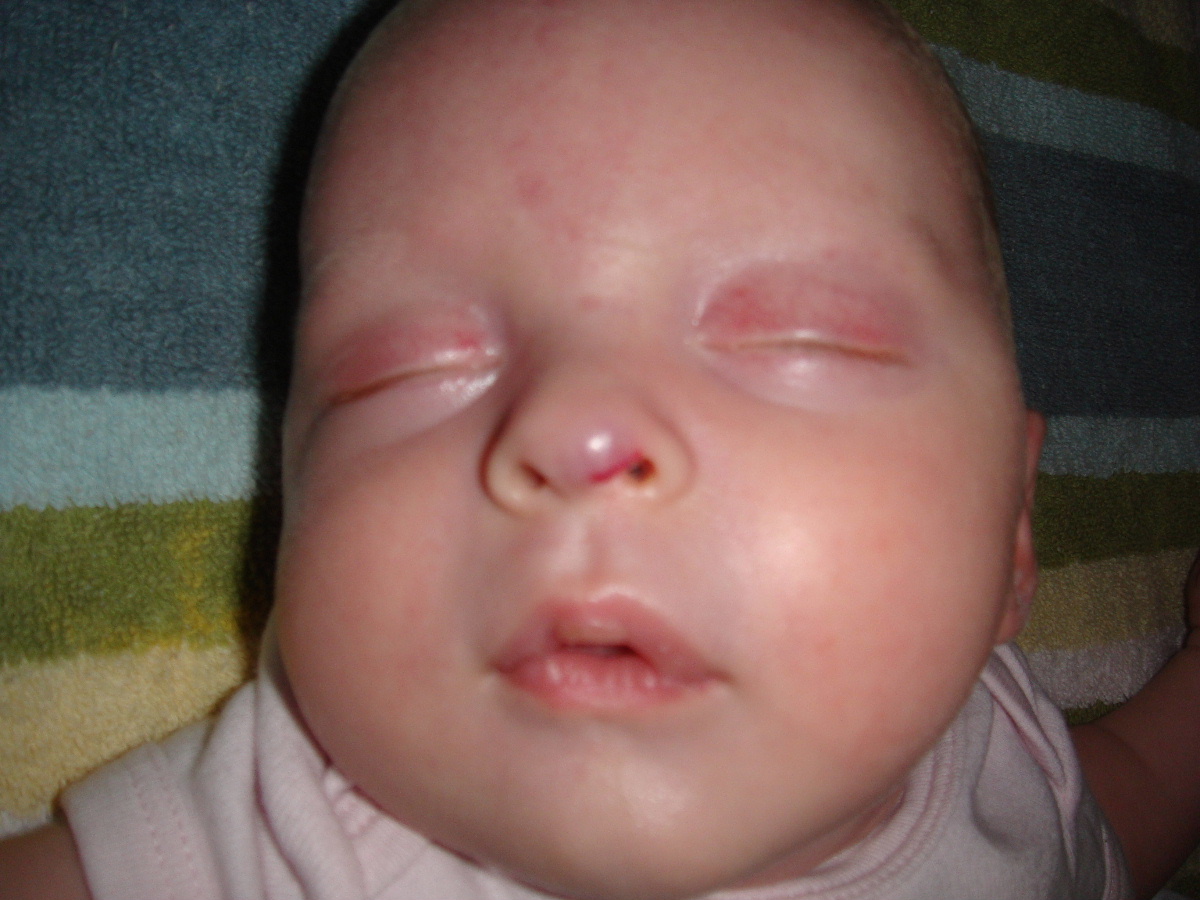 Infantile hemangiomas | Children's Hospital of Wisconsin